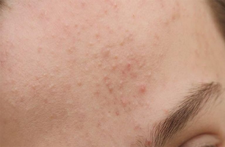 Thay đổi thời tiết khiến da mặt nổi sẩn và ngứa