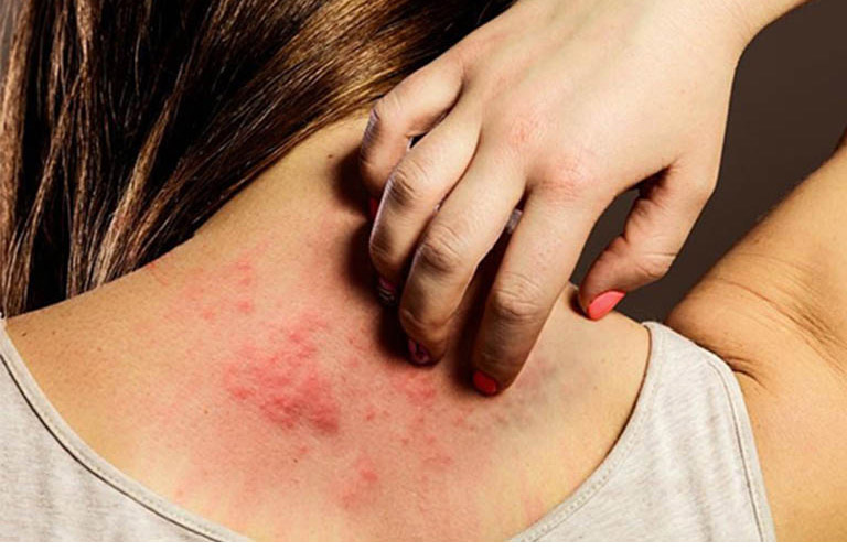 Bệnh phong ngứa do ký sinh trùng Sarcoptes scabiei gây ra.
