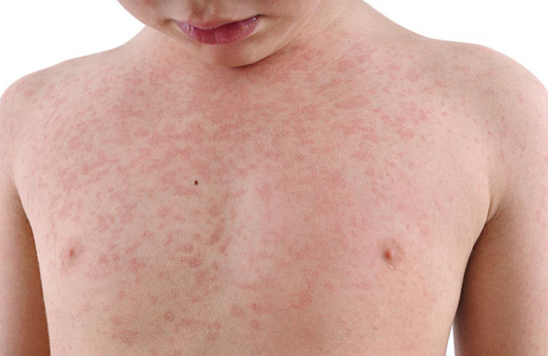 Trẻ nhỏ là đối tượng dễ bị phong ngứa