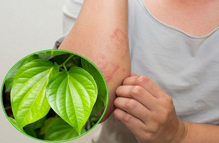 Lá trầu không có thể giảm ngứa, chống lại tác nhân gây bệnh mề đay