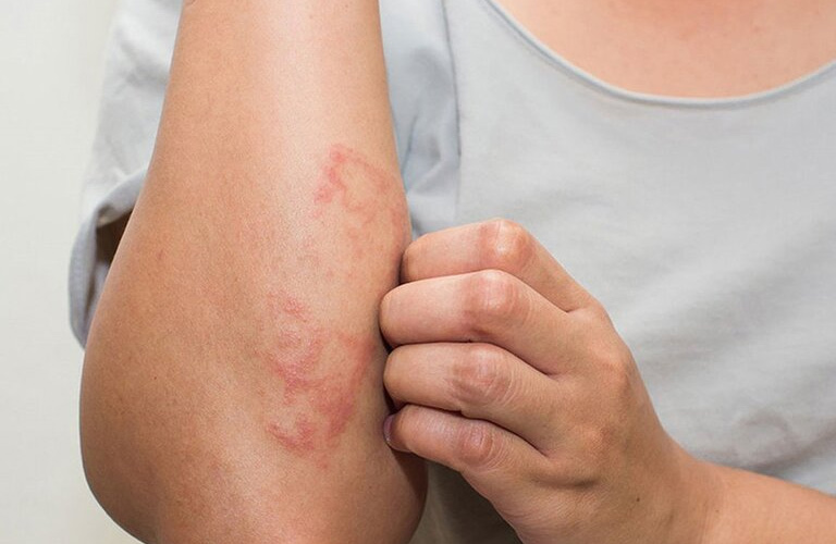 Nhiễm trùng có thể khiến da nổi mẩn ngứa