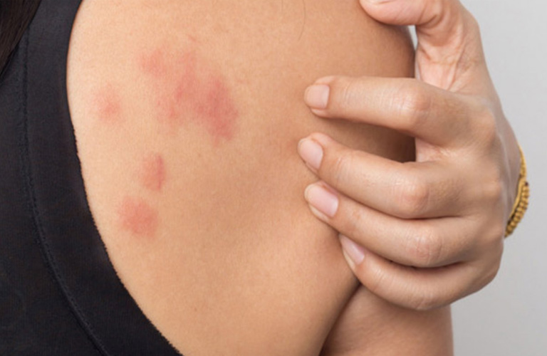 Người bệnh bị nổi mẩn ngứa, đặc biệt là ngứa thường gia tăng về đêm