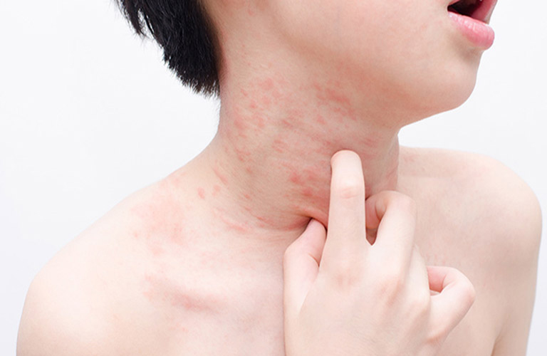 Vùng da mẩn ngứa kèm sưng, đỏ cần tới gặp bác sĩ ngay