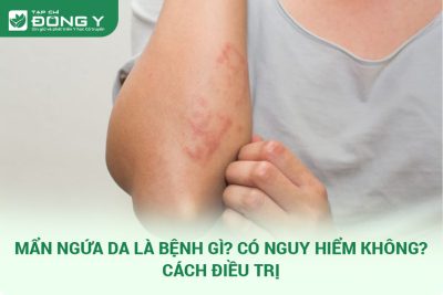 Mẩn Ngứa Da
