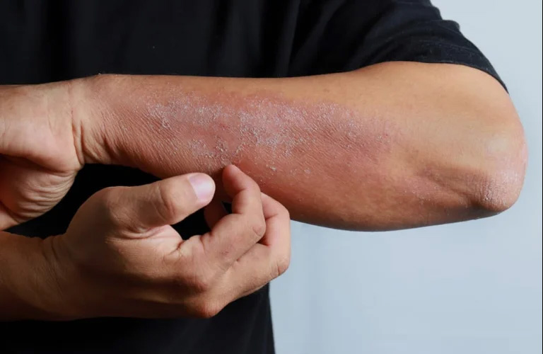 Viêm da cơ địa gây mẩn ngứa khắp người