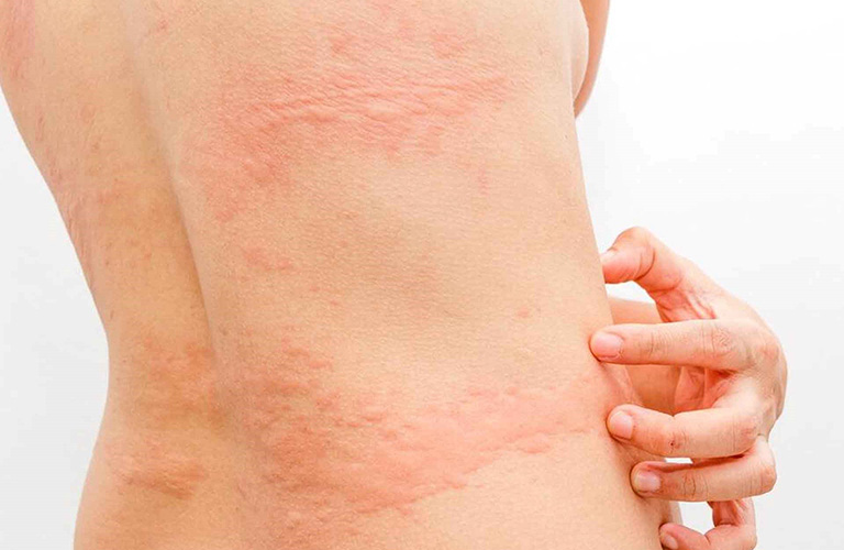 Mẩn ngứa khắp người do thay đổi thời tiết