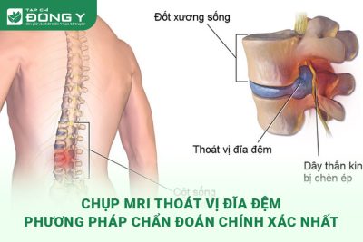 mri-thoat-vi-dia-dem