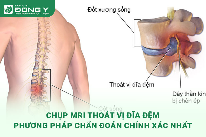 mri-thoat-vi-dia-dem