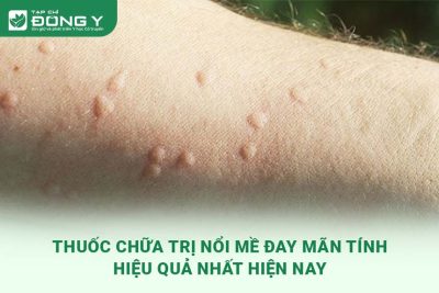 thuoc-tri-me-day-man-tinh
