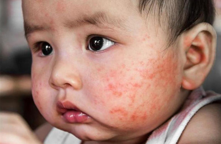 Côn trùng đốt có thể là nguyên nhân khiến bé nổi mẩn đỏ