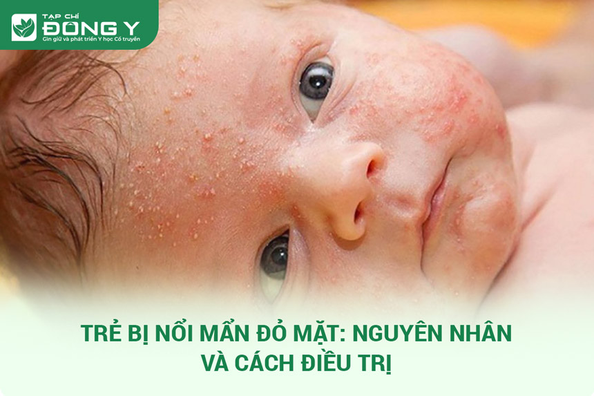 Trẻ bị nổi mẩn đỏ ở mặt