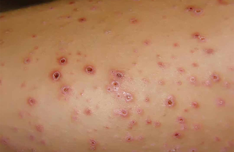 Vảy nến thể chấm giọt không phải là bệnh truyền nhiễm