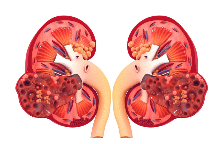 Vảy nến có thể gây suy thận nếu không được điều trị đúng cách