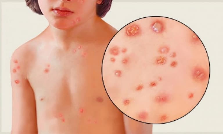 Bệnh nhân mắc nấm Penicillium marneffei bị nhiễm trùng toàn thân
