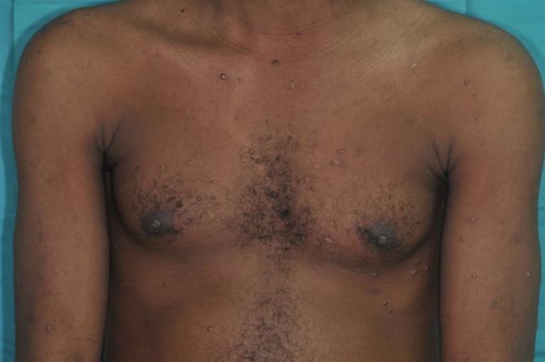 Xuất hiện những vết thương trên da người bệnh mắc Penicillium marneffei