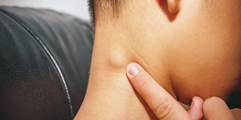 Bệnh nhân mắc Penicillium marneffei nổi hạch to ở cổ 