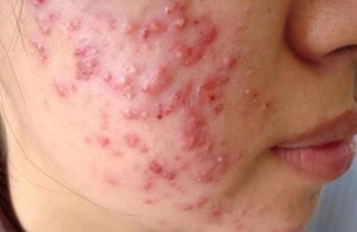 Điều trị mụn trứng cá không khỏi do rất nhiều nguyên nhân