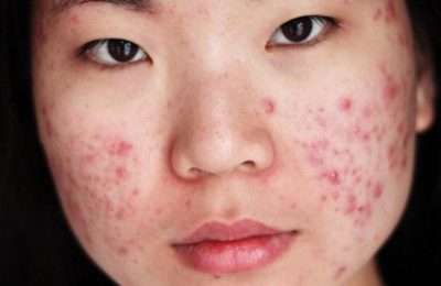 Sự thay đổi nội tiết tố là một trong những nguyên nhân gây nên mụn trứng cá