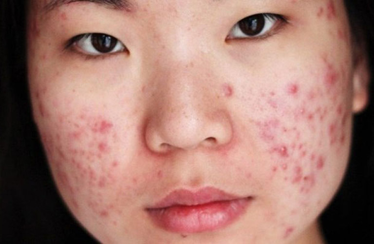 Sự thay đổi nội tiết tố là một trong những nguyên nhân gây nên mụn trứng cá