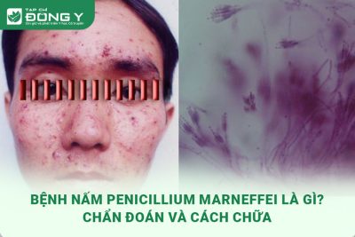 benh nam penicillium marneffei