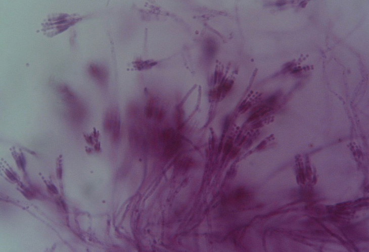 benh nam penicillium marneffei