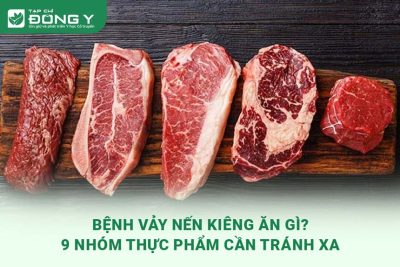 benh-vay-nen-kieng-an-gi