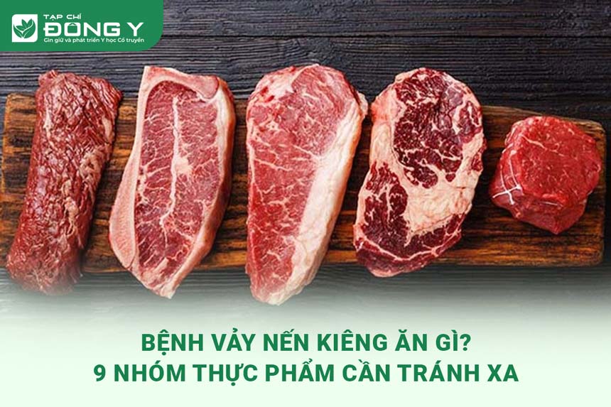 benh-vay-nen-kieng-an-gi