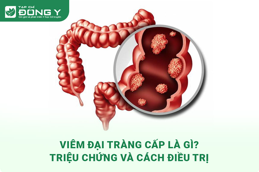 viem-dai-trang-cap-tinh