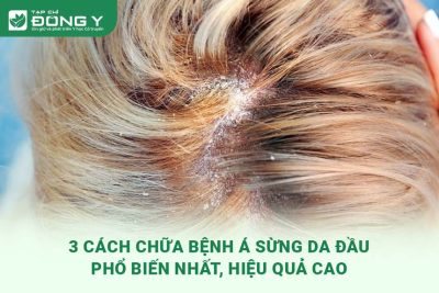 cach-chua-benh-a-sung-da-dau