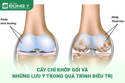 cay-chi-khop-goi-va-nhung-luu-y-trong-qua-trinh-dieu-tri