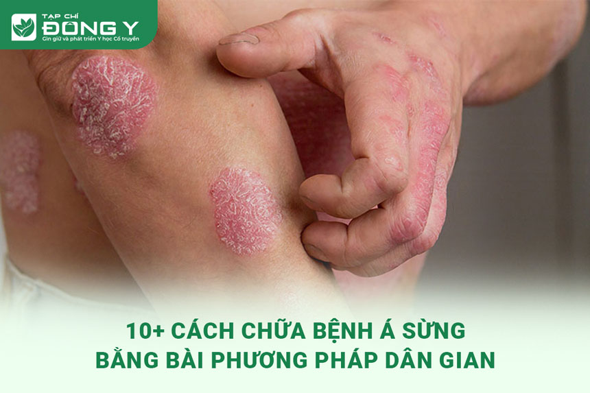 chua-benh-a-sung-bang-bai-thuoc-dan-gian