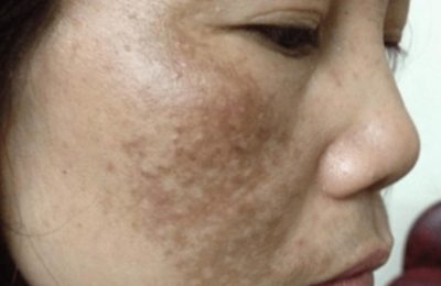 Nám tàn nhang khiến nữ giới mất tự tin trong giao tiếp