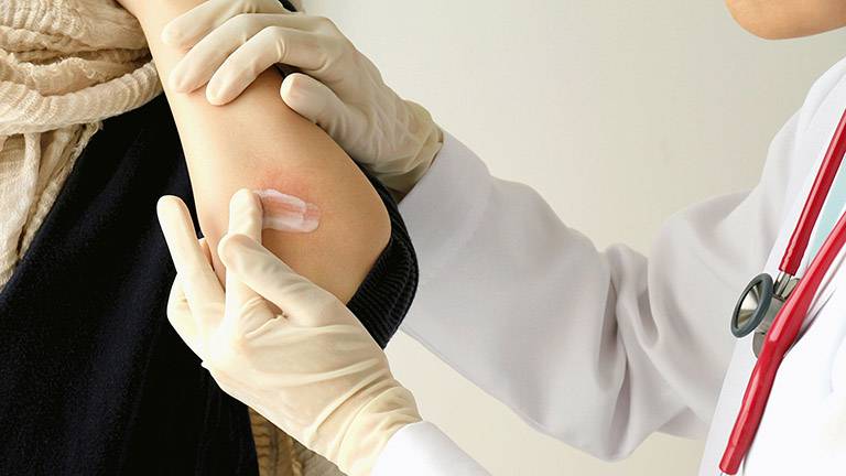 Thuốc dạng bôi được sử dụng phổ biến trong điều trị viêm da tiết bã