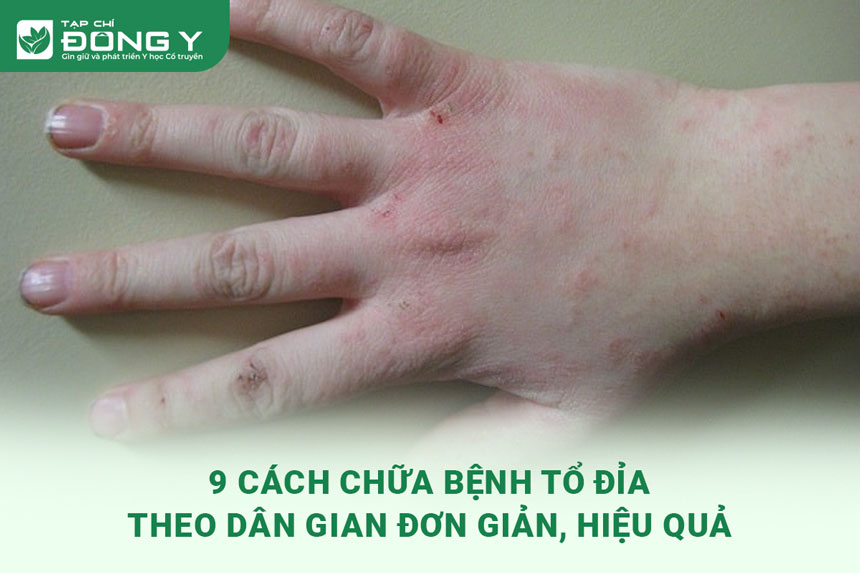 cach-chua-benh-to-dia-theo-dan-gian