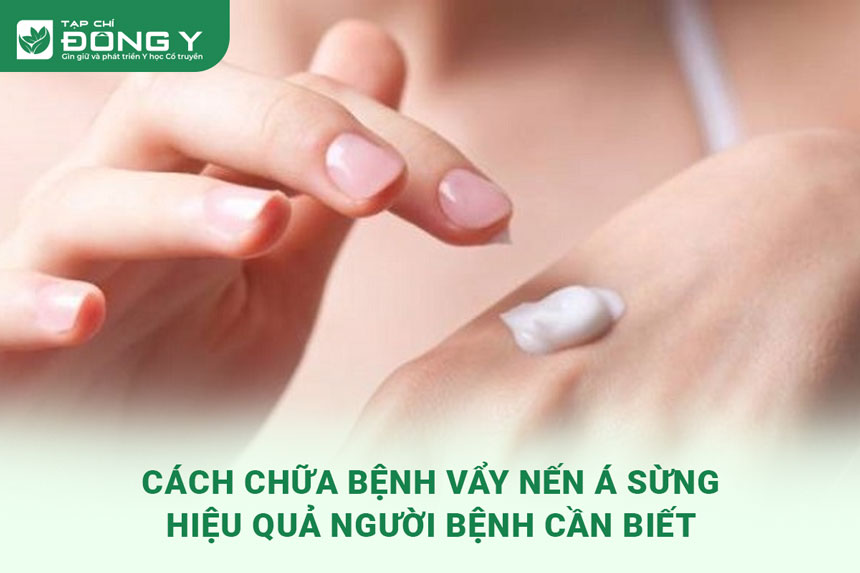 cach-chua-benh-vay-nen-a-sung