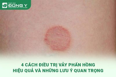 dieu-tri-vay-phan-hong