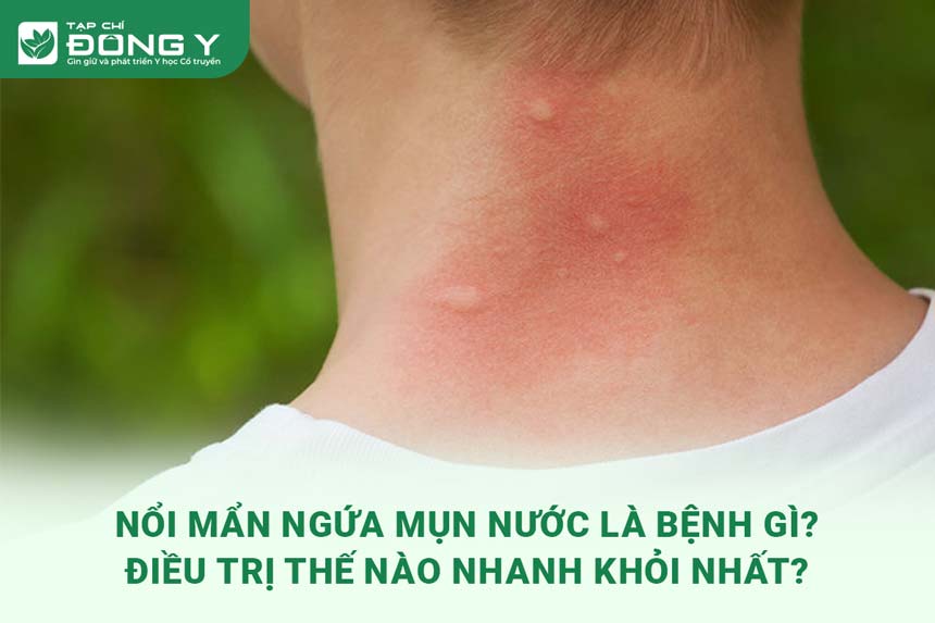man-ngua-mun-nuoc