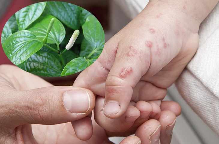 Lá lốt và công dụng trong điều trị bệnh viêm da cơ địa