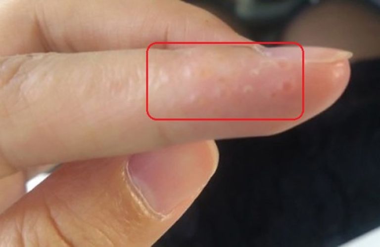 Nổi mẩn ngứa và mụn nước nhiều là dấu hiệu bệnh viêm da dị ứng