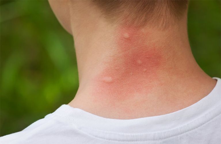 Nổi mẩn ngứa và mụn nước cảnh báo bệnh gì?