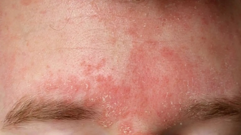 Viêm da tiết bã là bệnh lý cần được điều trị từ sớm và đúng cách