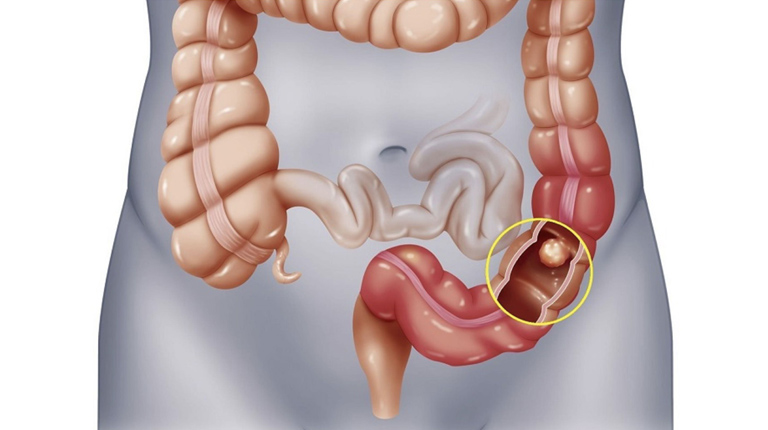 Viêm đại tràng cấp không điều trị kịp thời dễ gây thủng dạ dày