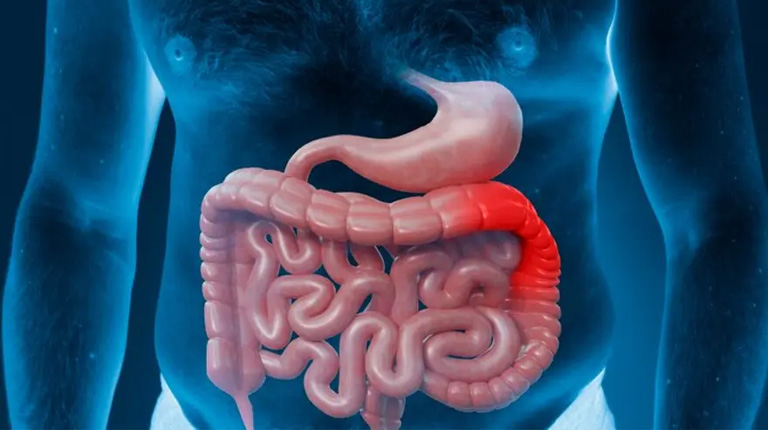 Viêm đại tràng cấp là căn bệnh phổ biến, đang có chiều hướng gia tăng