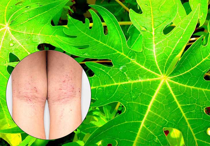 Tác dụng lá đu đủ trong chữa viêm da cơ địa