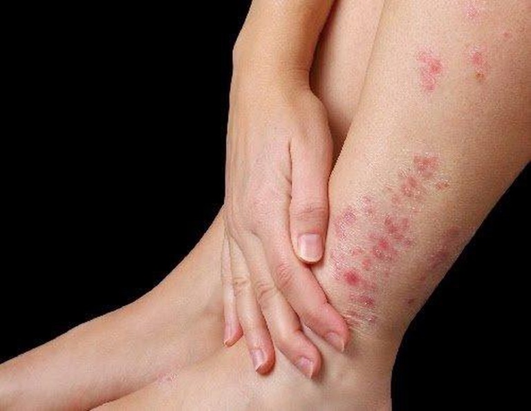Cách này chỉ nên áp dụng với trường hợp bệnh nhẹ, mới khởi phát