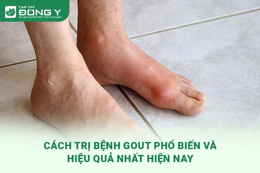 dieu-tri-gout