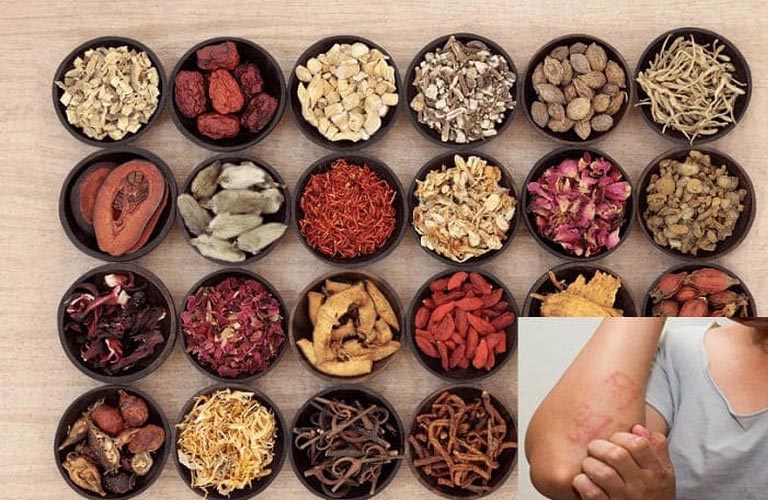 Điều trị viêm da cơ địa vùng kín bằng thuốc Đông y hiệu quả và lành tính