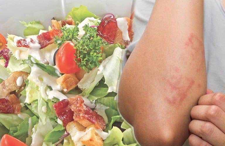 Đảm bảo chế độ dinh dưỡng sinh hoạt điều độ giúp phòng bệnh viêm da cơ địa