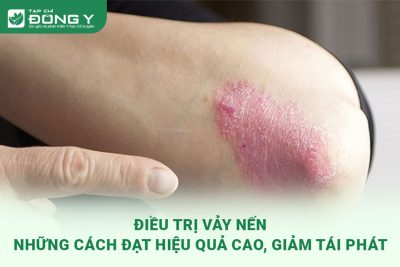 dieu-tri-vay-nen