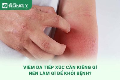 viem-da-tiep-xuc-can-kieng-gi